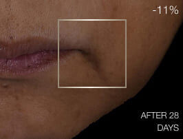 Primo piano della pelle prima del trattamento, con solchi naso-labiali visibili e segni di invecchiamento intorno alla bocca.